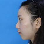 全切双眼皮日记 扬州雷医生整形 烧麦麦的分享共5篇 悦美整形